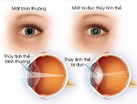 Mắt mờ đột ngột, coi chừng mất thị lực vĩnh viễn