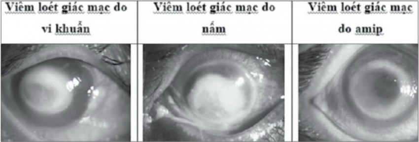 Hình thể sán lá phổi trưởng thành.