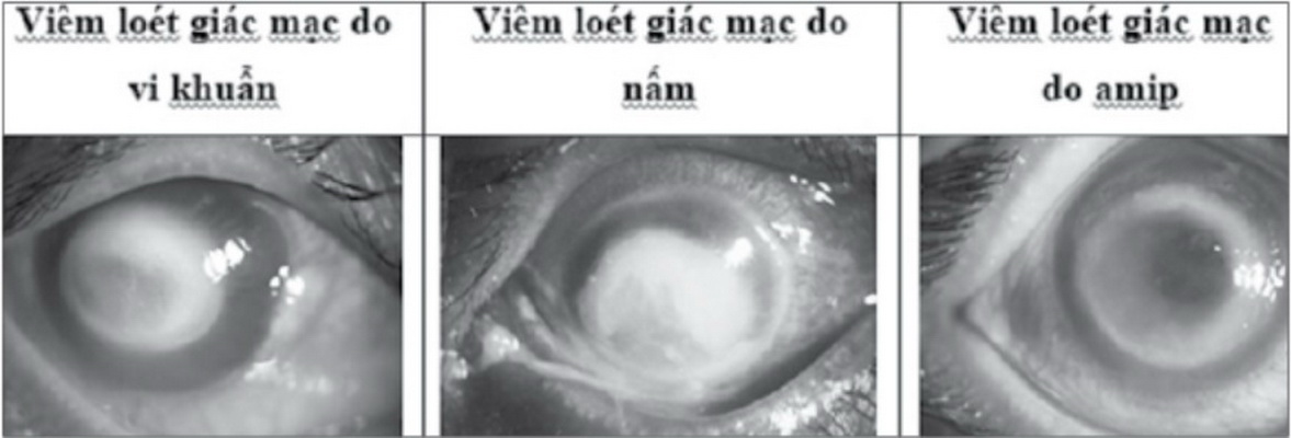 Chấn thương mắt do làm nông có thể gây mù