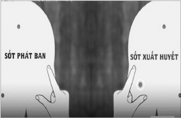 Phân biệt giữa sốt xuất huyết và sốt phát ban ở trẻ