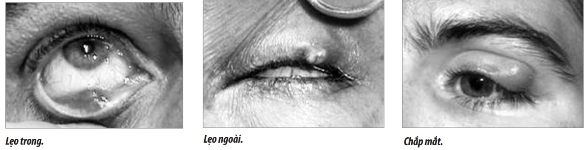 Nhận diện chắp và lẹo mắt