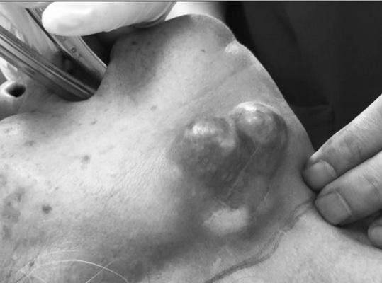 Nhận biết ung thư tuyến nước bọt giai đoạn sớm