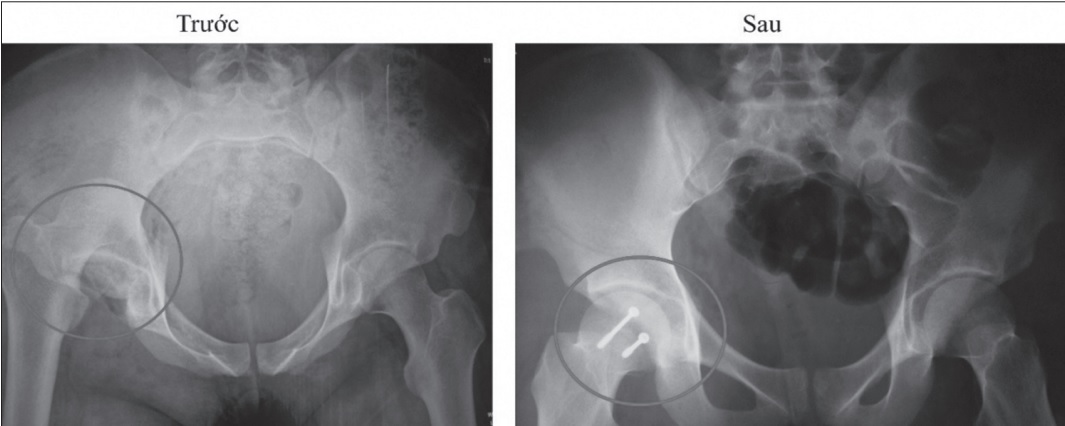 Ai dễ bị hoại tử chỏm xương đùi?