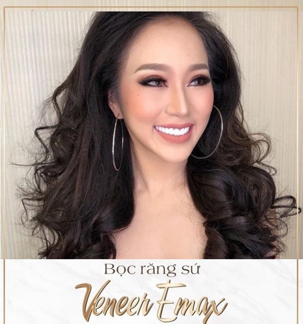 veneer emax