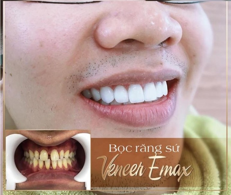 veneer emax
