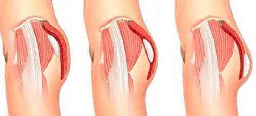 vị trí đặt túi nâng mông