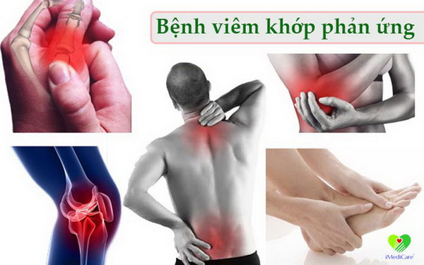 Chữa trị sớm viêm khớp phản ứng để tránh biến chứng