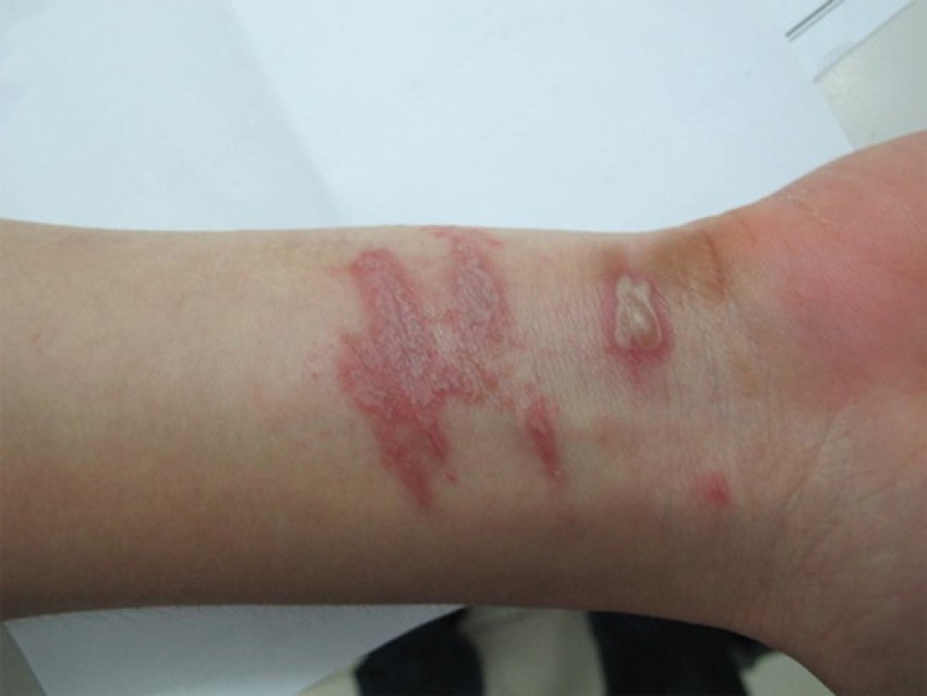 Viêm da tiếp xúc do kiến ba khoang.