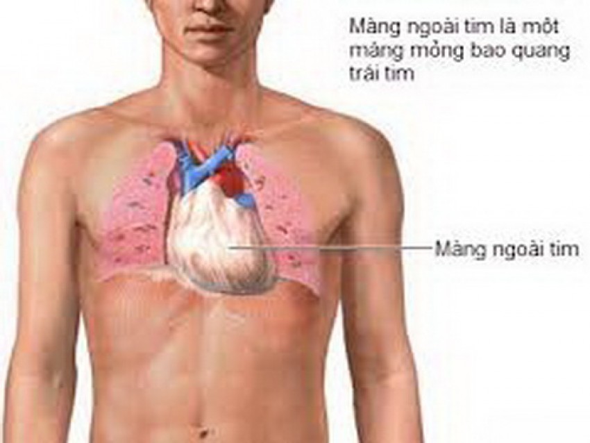 Lao là nguyên nhân hàng đầu gây viêm màng ngoài tim co thắt.