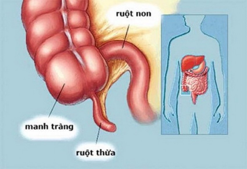 Viêm túi thừa manh tràng xảy ra khi một hoặc nhiều túi thừa của ống tiêu hóa bị nhiễm khuẩn.