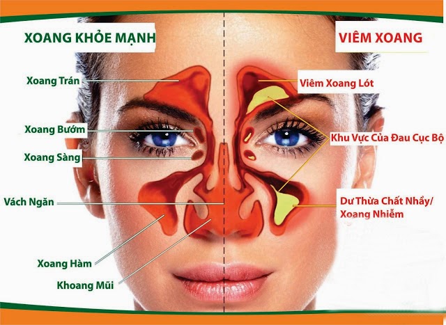Ðông y chữa viêm mũi mạn tính