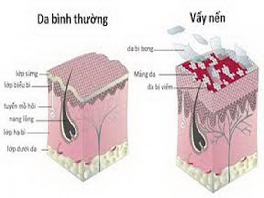 Vảy nến da đầu.