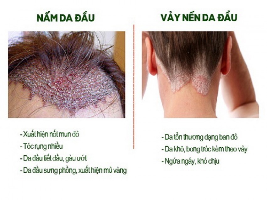 Các dấu hiệu phân biệt giữa nấm da đầu và vảy nến da đầu.