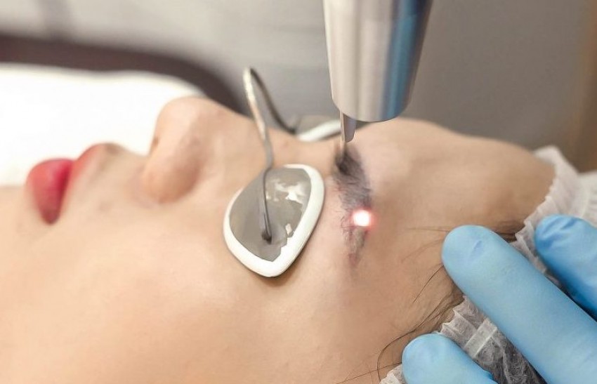 Phương pháp xóa xăm bằng laser