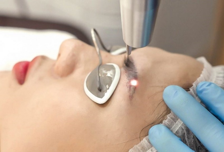 công nghệ xóa lông mày bằng laser