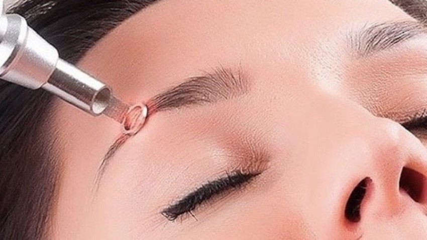 xóa laser bao nhiêu lần