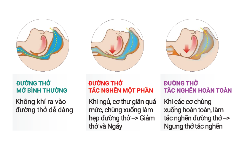 HỘI CHỨNG NGƯNG THỞ KHI NGỦ - SLEEP APNEA